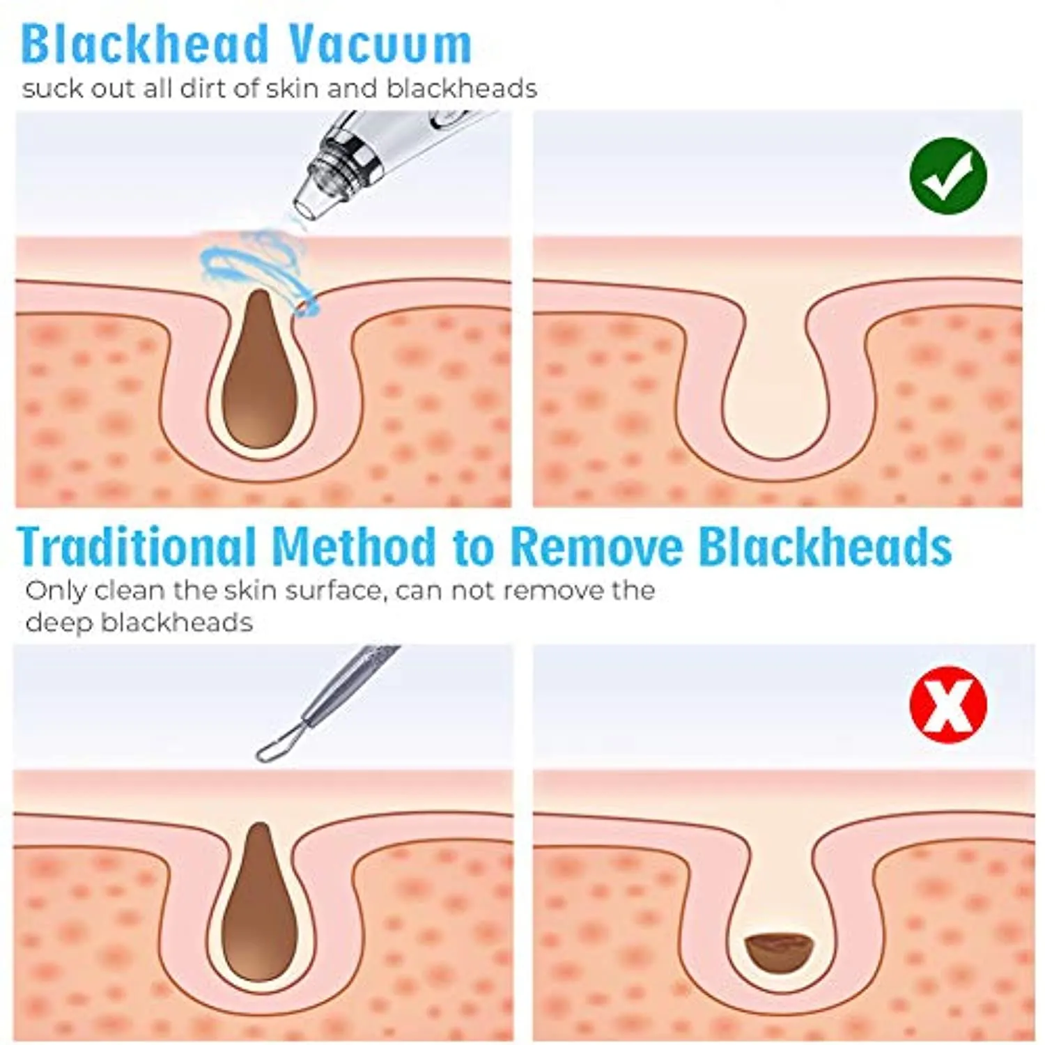 2022 Newest Blackhead Remover Pore Vacuum,Upgraded Facial Pore Cleaner,Electric Acne Comedone Whitehead Extractor Tool-5 Suction Power,5 Probes,USB Rechargeable Blackhead Vacuum Kit for Women & Men