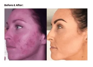5-in-1 Skin Mesotherapy Treatment Device