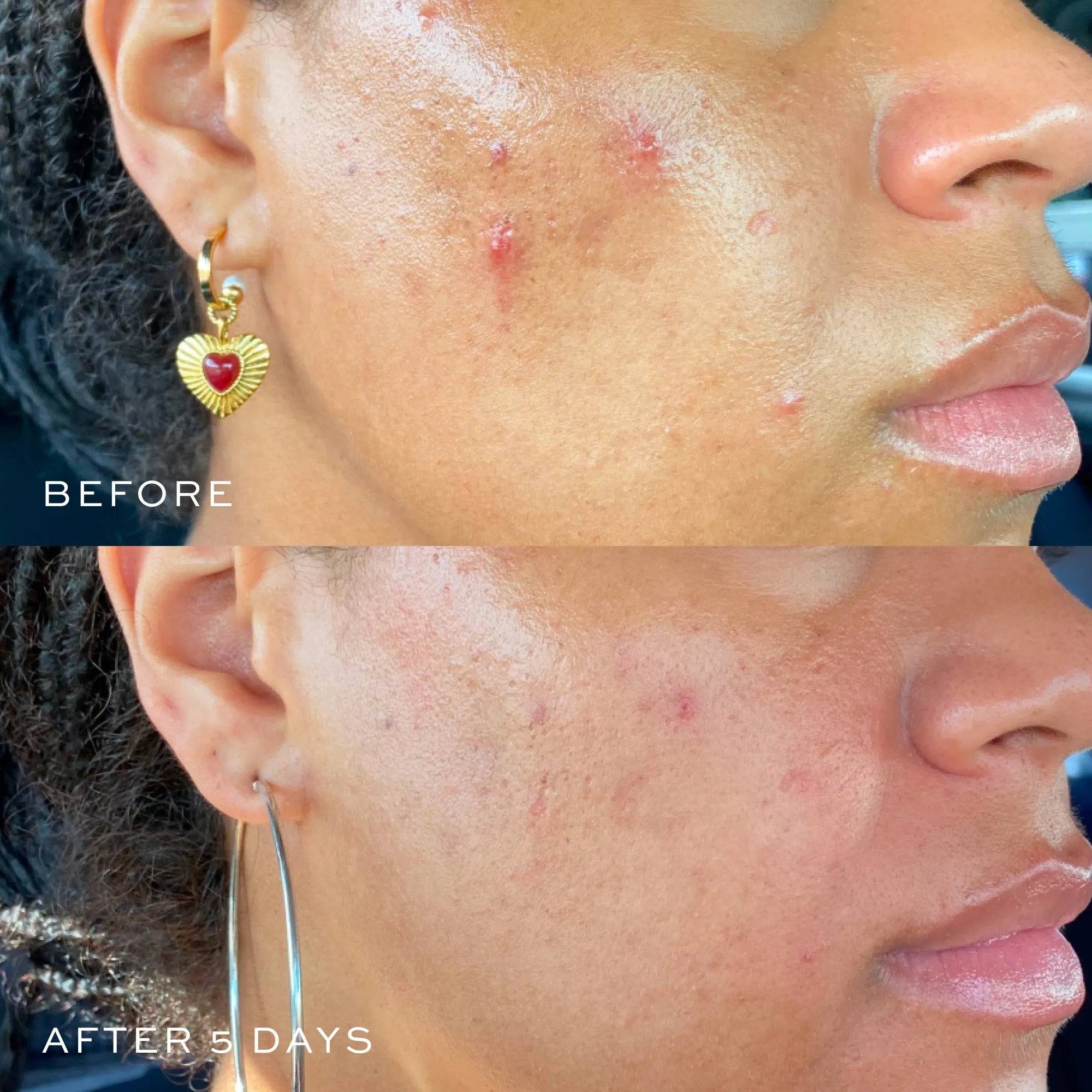 Acne Spot Treatment