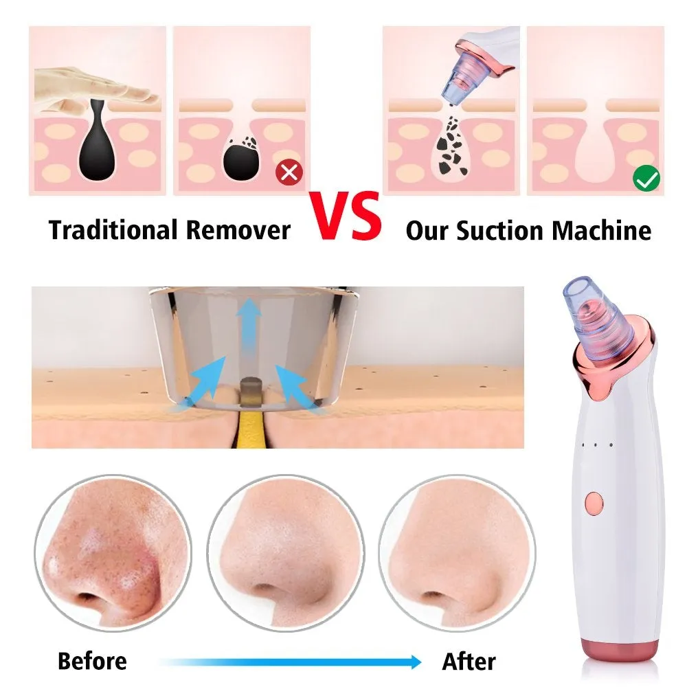Aibeau Blackhead Remover Electric Blackhead Vacuum Suction Rechargeable Whitehead Remover Tool Kite Cleanser with 4 Replaceable Heads, Hot Pack Function and 3 Modes