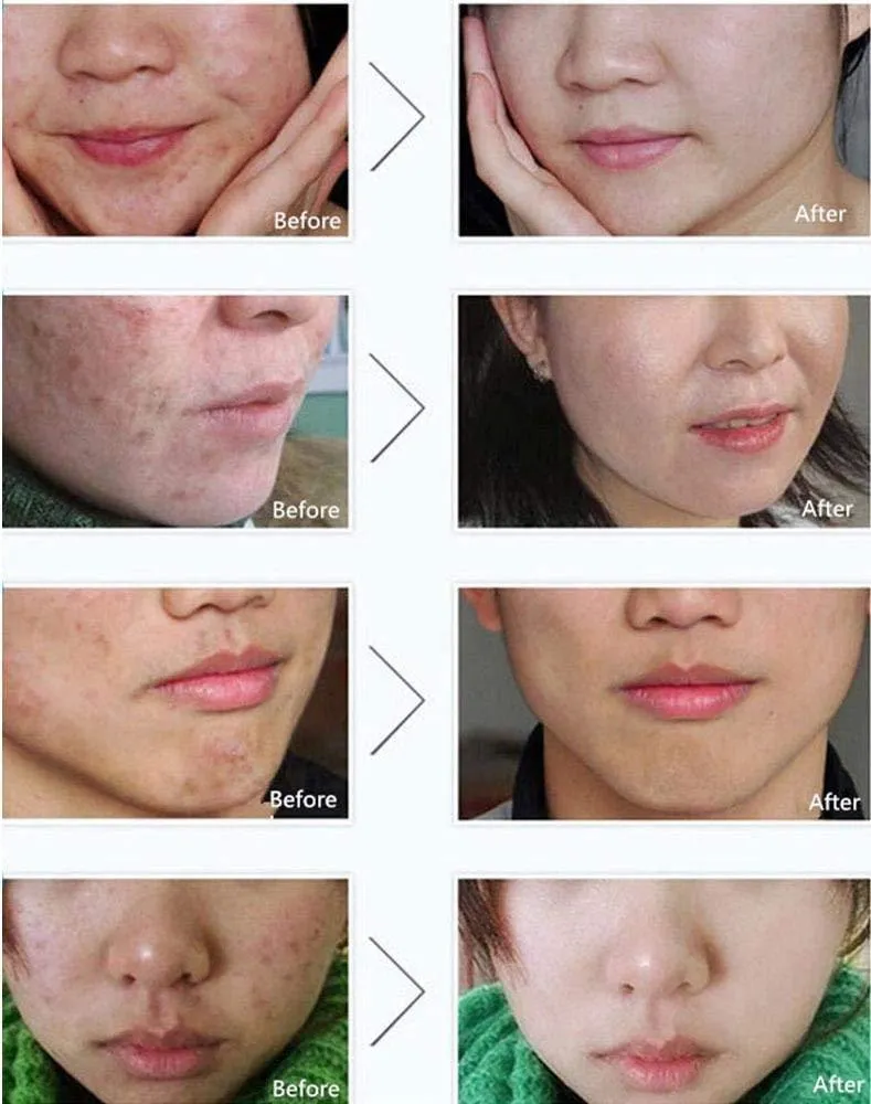 Anti Blackhead Removal Acne Cream