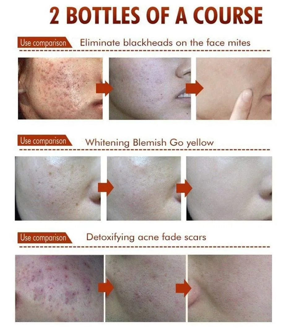 Anti Blackhead Removal Acne Cream