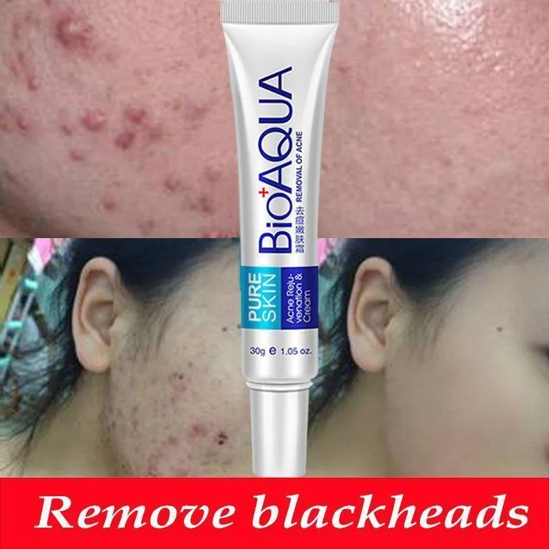 Anti Blackhead Removal Acne Cream