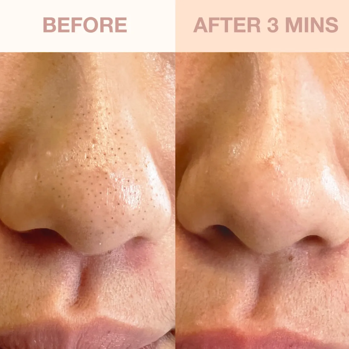 Berry Clear Skin Set | with Deepcare O2 Hydro-Facial Pore Refiner Device & Armour Serum