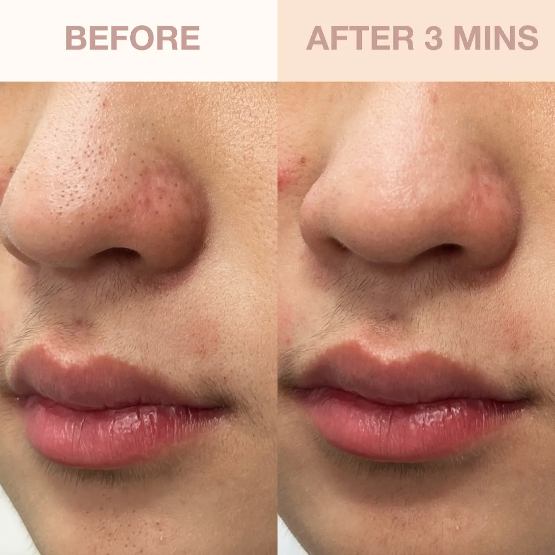 Berry Clear Skin Set | with Deepcare O2 Hydro-Facial Pore Refiner Device & Armour Serum