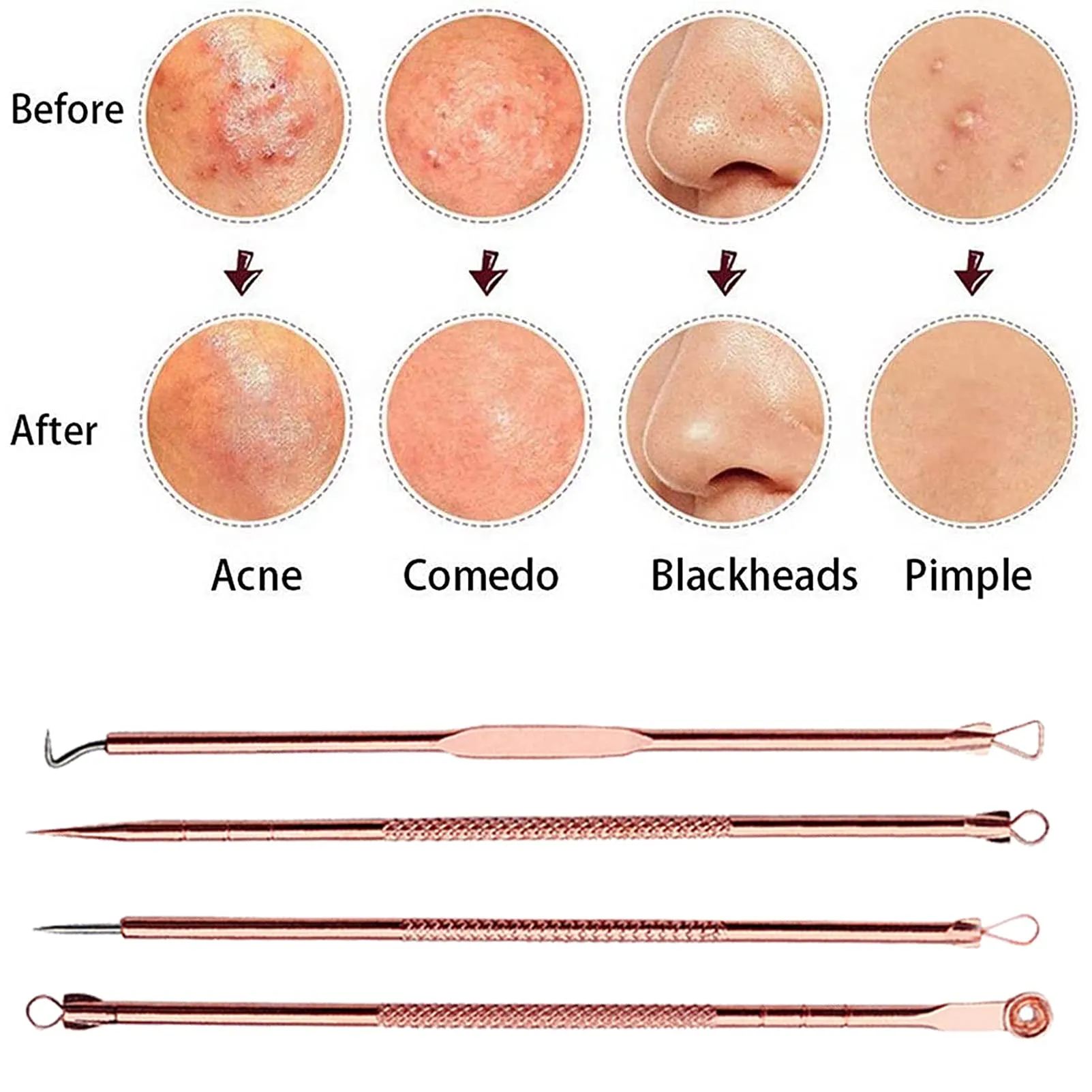 Blackhead Remover Tool Kit,4 Pieces Comedone Extractor Tool Blemish Whitehead Removal Acne Needle Pimple Spot Popper Stainless Steel (Gold) Gold