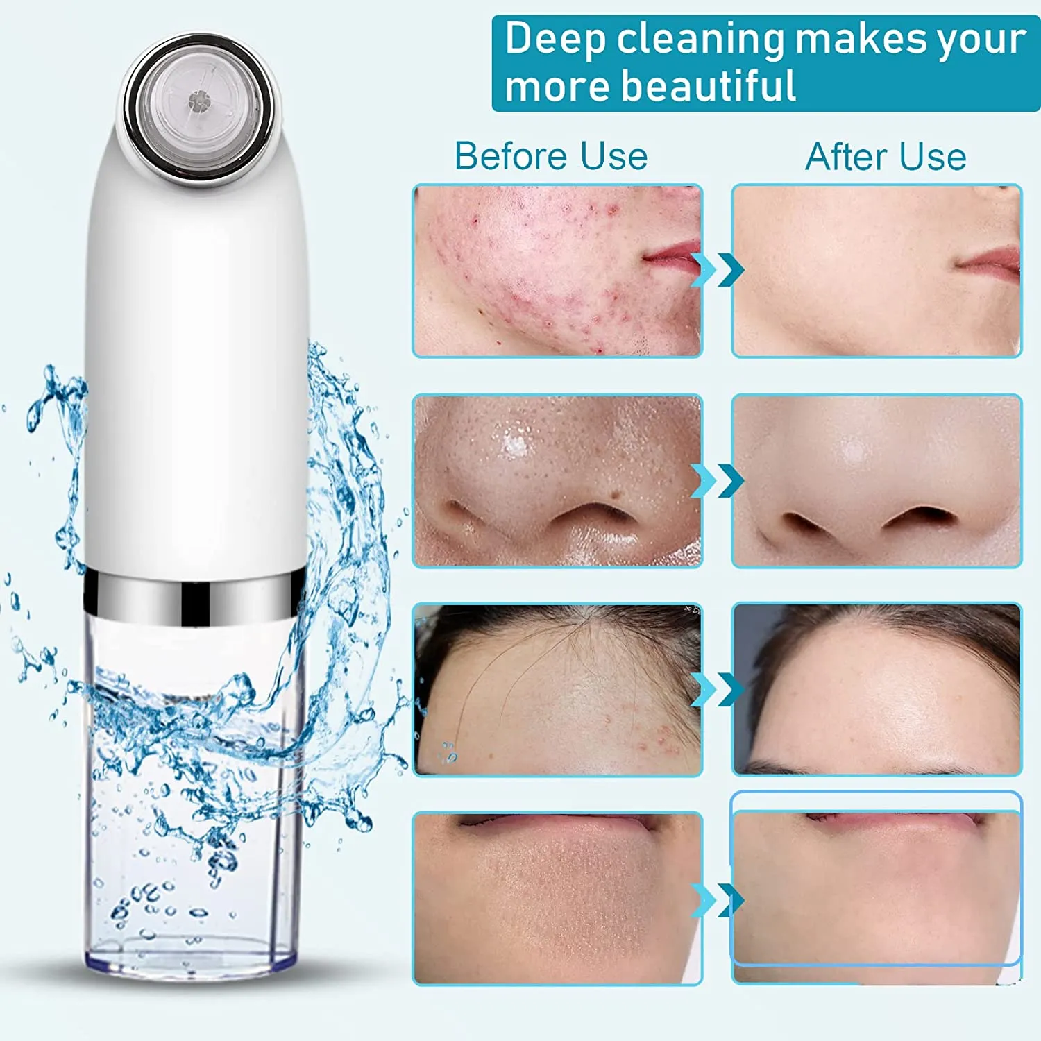 Electric Acne Tool Set USB Charging Blackhead Remover Pore Vacuum Face Massager Pimple Popper Kit