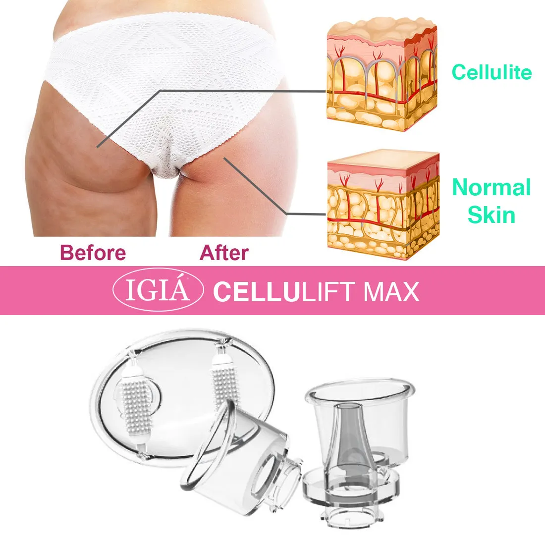 IGIA™ Cellulift Max Suction