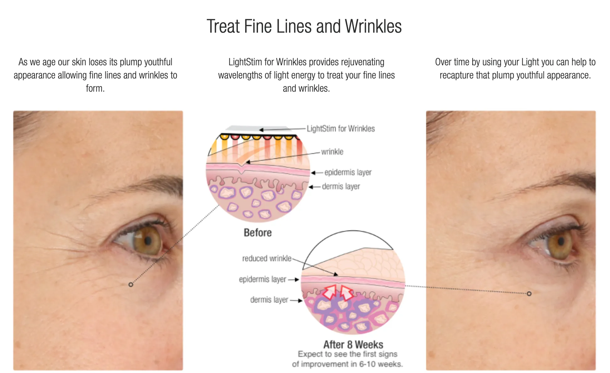LightStim for Wrinkles