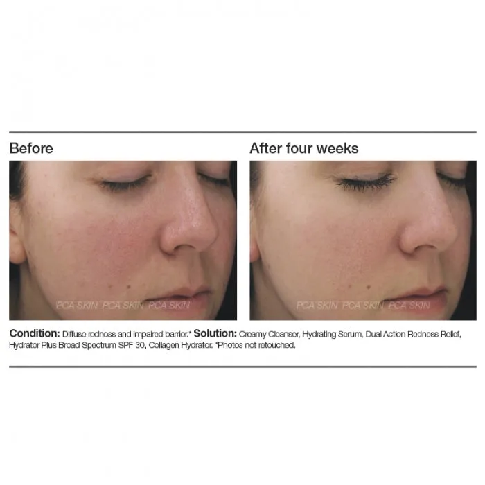 PCA Dual Action Redness Relief