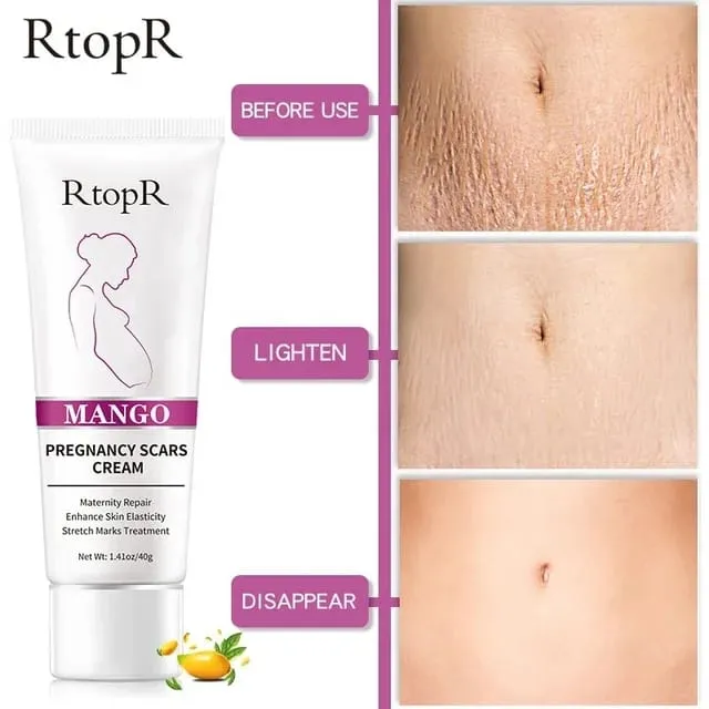 RtopR Natural Herbal Mango Stretch Marks and Scar Removal Cream for Pregnancy
