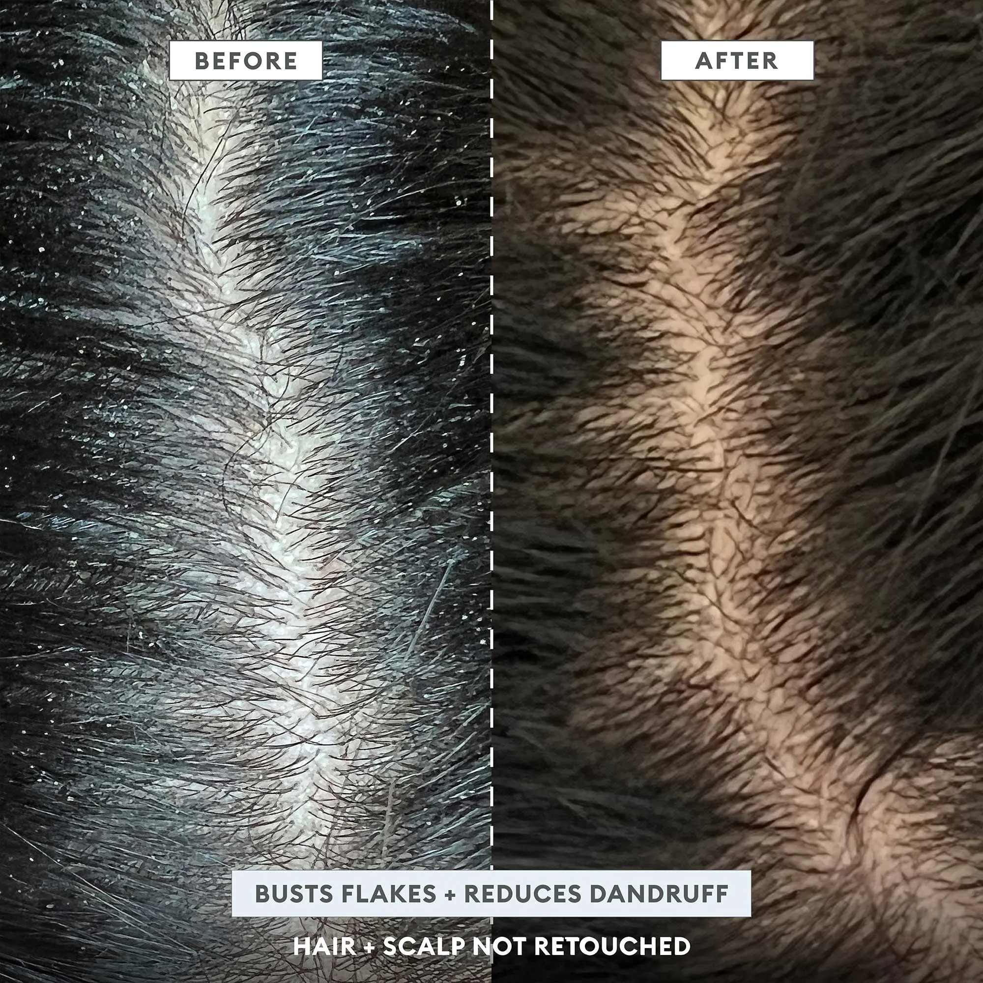 Scalp Revival™ Dandruff Relief Complete Set
