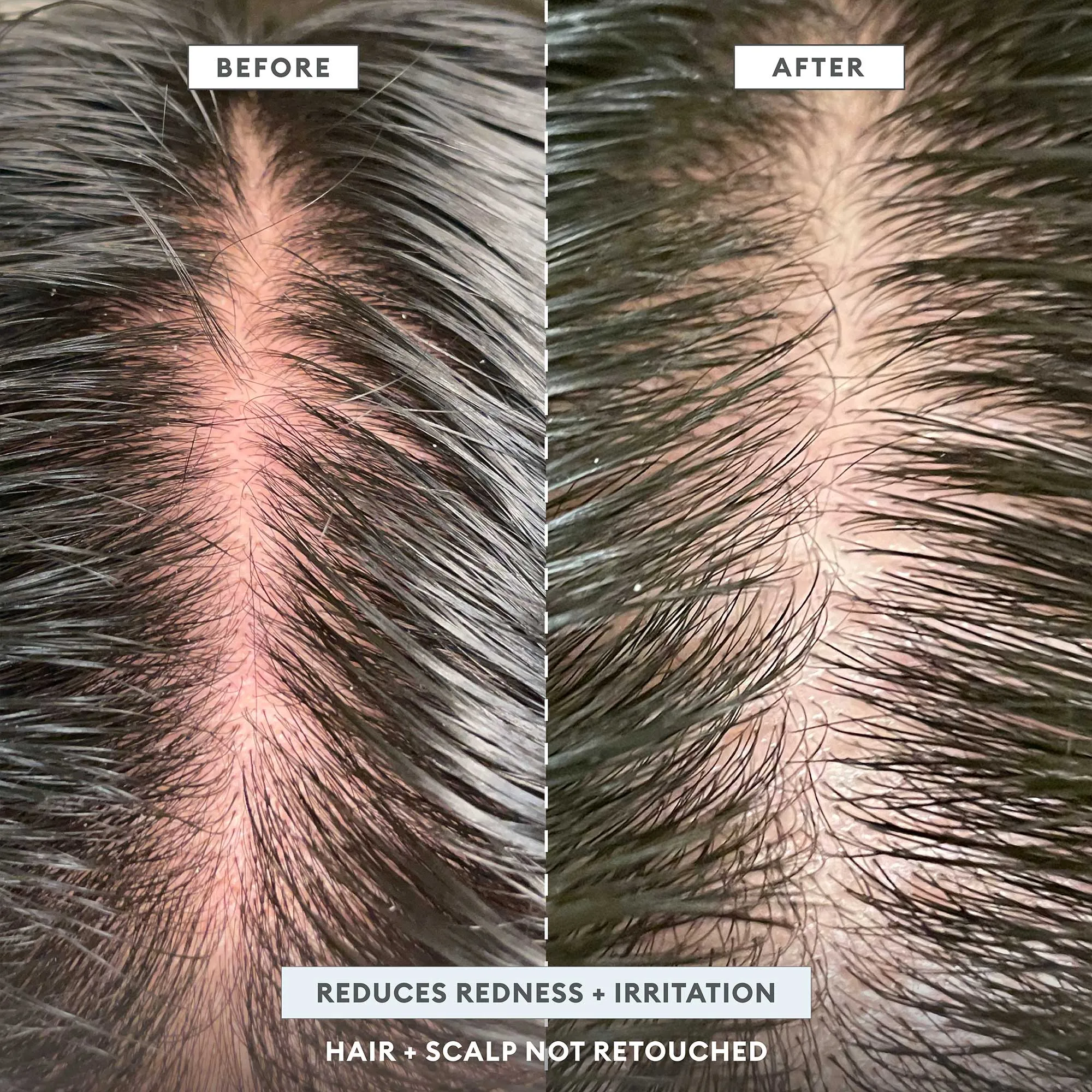 Scalp Revival™ Dandruff Relief Complete Set