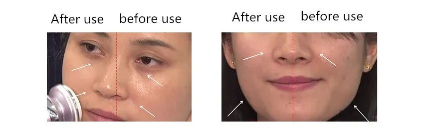 Skin Tightening RF Massager
