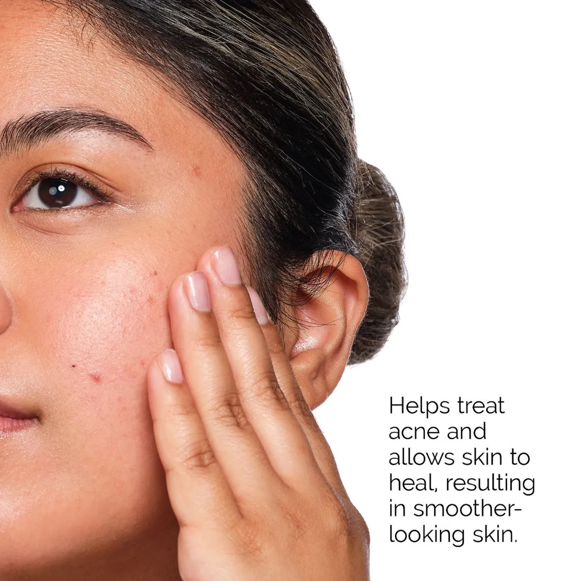 THE ORDINARY the acne set including salysilc acid 2% solution for the treatmint of acne مجموعة الساليسيلك اسد للعناية بالبشرة
