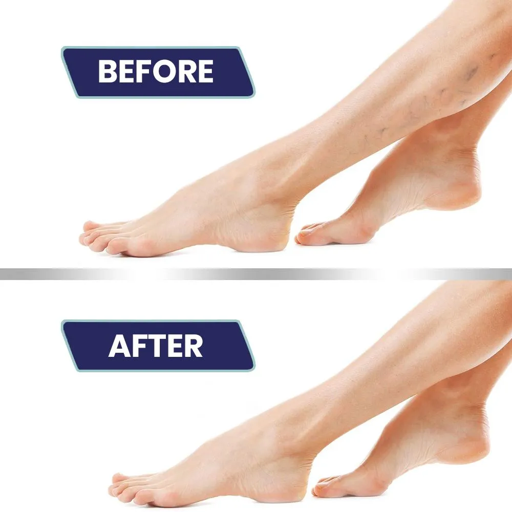 Varicose Veins Cream